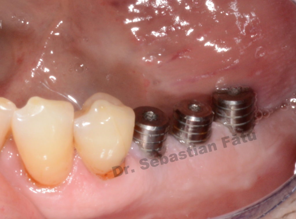 implanturi-dentare