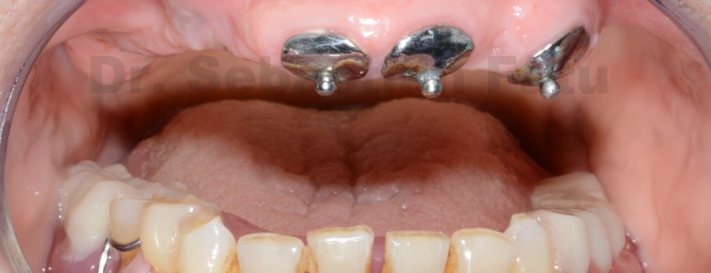 proteza-dentara-cu-capse