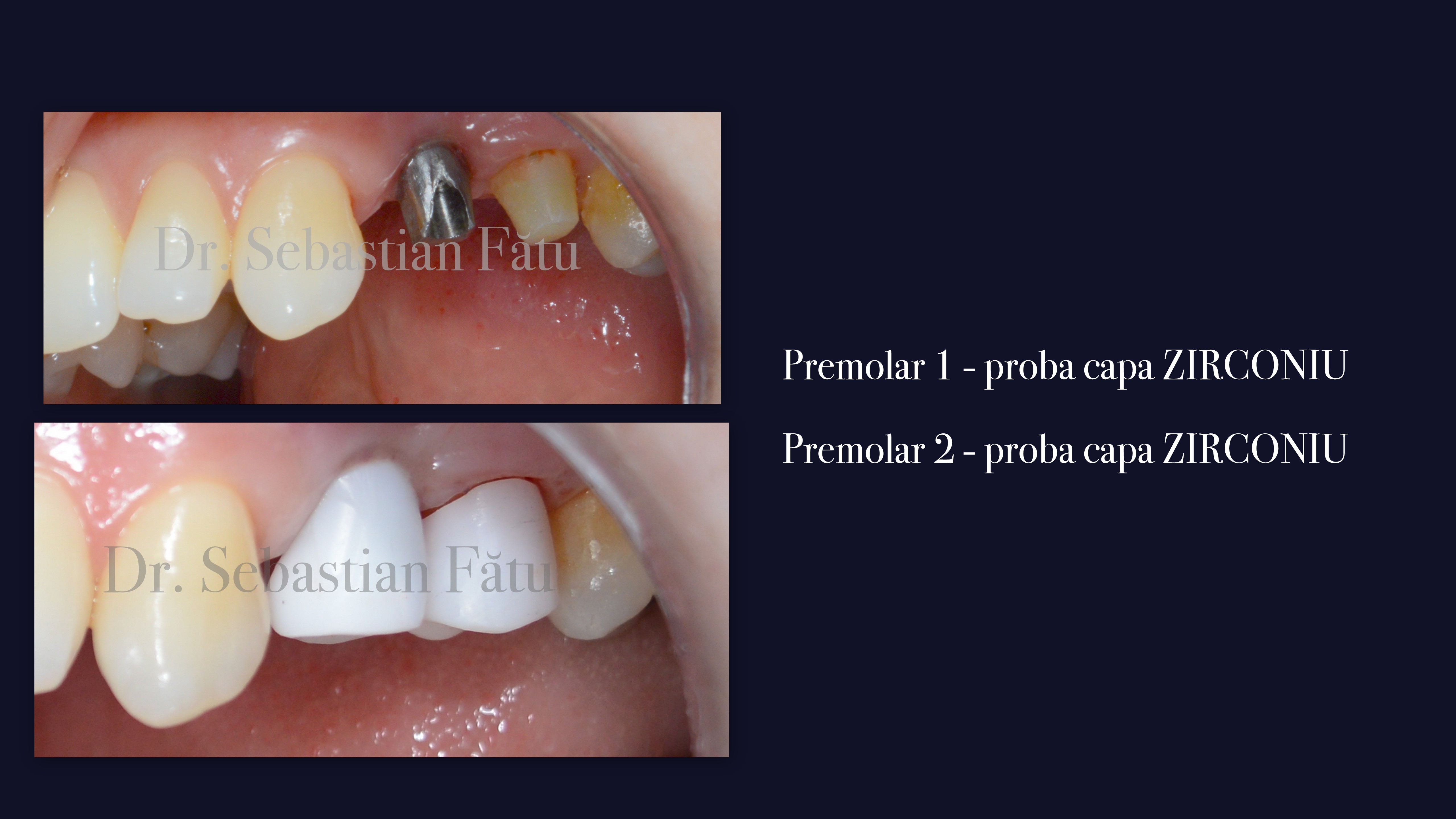 Shopkeeper Dean pneumonia pivot fibra sticla | Lucrări dentare complexe.